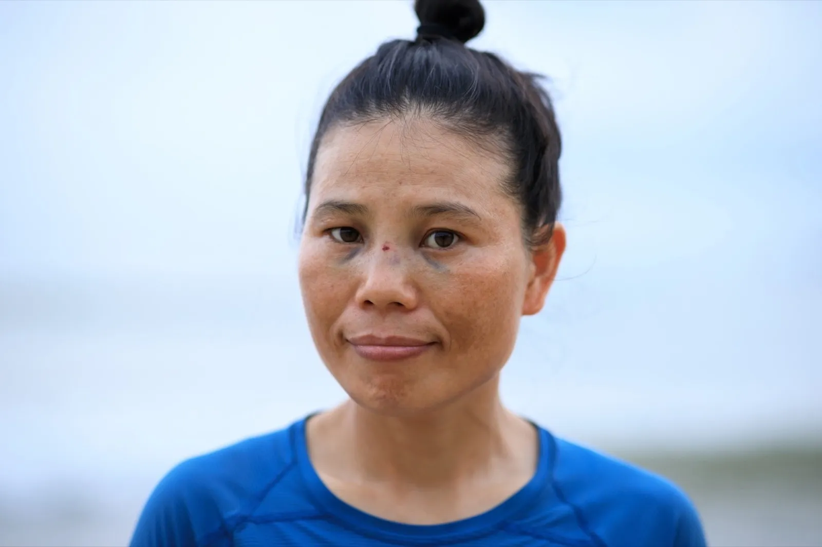 Woman with injured eyes